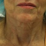 Morpheus8 Before & After Patient #1786