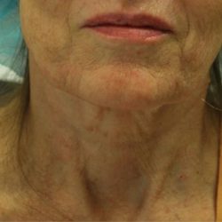 Morpheus8 Before & After Patient #1786