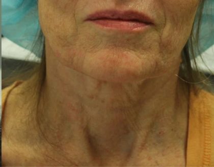 Morpheus8 Before & After Patient #1786