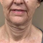 Morpheus8 Before & After Patient #1790