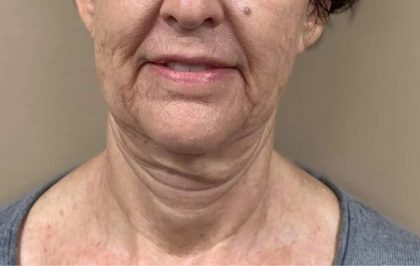 Morpheus8 Before & After Patient #1790