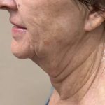Morpheus8 Before & After Patient #1790