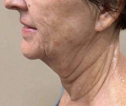 Morpheus8 Before & After Patient #1790