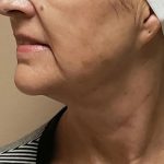 Morpheus8 Before & After Patient #1790
