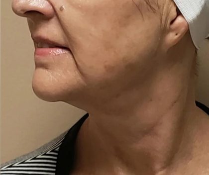 Morpheus8 Before & After Patient #1790