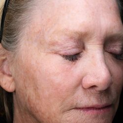 Fractional Laser Before & After Patient #1856