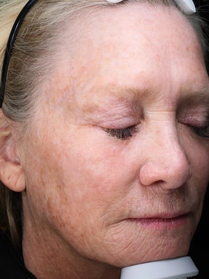 Fractional Laser Before & After Patient #1856