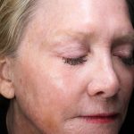 Fractional Laser Before & After Patient #1856