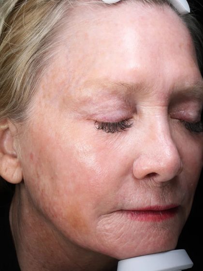 Fractional Laser Before & After Patient #1856