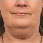 Coolsculpting Before & After Patient #1903