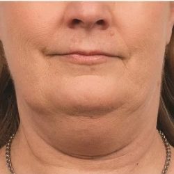 Coolsculpting Before & After Patient #1903