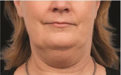 Coolsculpting Before & After Patient #1903
