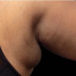 Coolsculpting Before & After Patient #1893