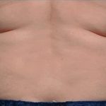 Coolsculpting Before & After Patient #1902