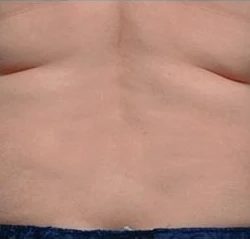 Coolsculpting Before & After Patient #1902