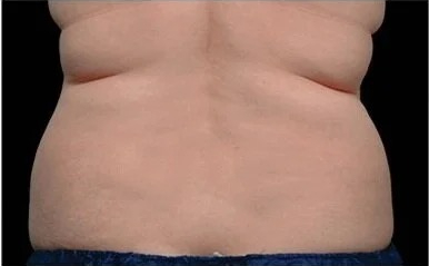 Coolsculpting Before & After Patient #1902