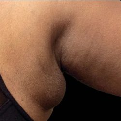 Coolsculpting Before & After Patient #1893