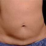 Coolsculpting Before & After Patient #1904