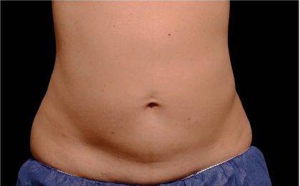 Coolsculpting Before & After Patient #1904