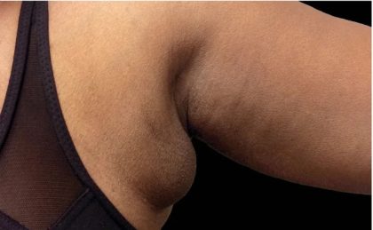 Coolsculpting Before & After Patient #1893
