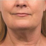 Coolsculpting Before & After Patient #1903