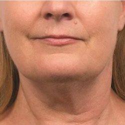 Coolsculpting Before & After Patient #1903