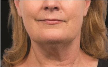 Coolsculpting Before & After Patient #1903