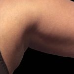 Coolsculpting Before & After Patient #1893