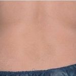 Coolsculpting Before & After Patient #1902