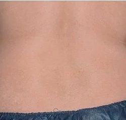 Coolsculpting Before & After Patient #1902