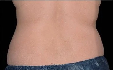 Coolsculpting Before & After Patient #1902