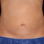 Coolsculpting Before & After Patient #1904