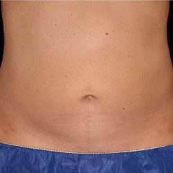 Coolsculpting Before & After Patient #1904