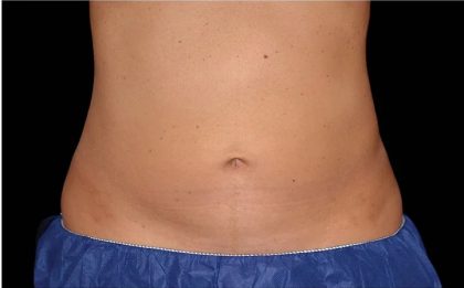 Coolsculpting Before & After Patient #1904
