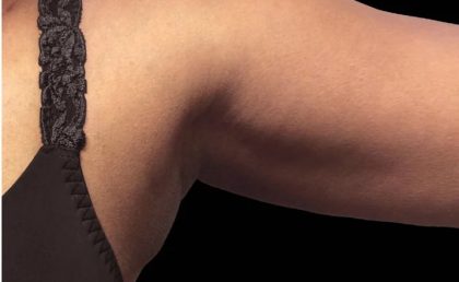 Coolsculpting Before & After Patient #1893