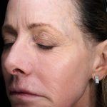 Fractional Laser Before & After Patient #1857