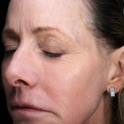 Fractional Laser Before & After Patient #1857