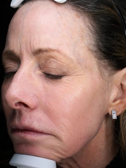 Fractional Laser Before & After Patient #1857