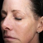 Fractional Laser Before & After Patient #1857