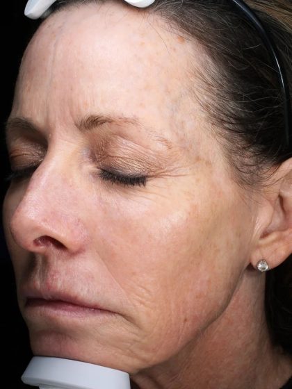 Fractional Laser Before & After Patient #1857