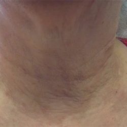 Fractional Laser Before & After Patient #1863
