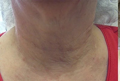 Fractional Laser Before & After Patient #1863