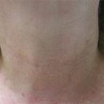 Fractional Laser Before & After Patient #1863