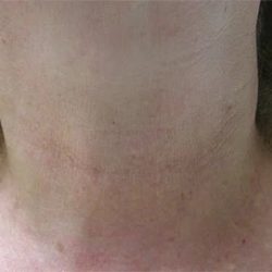 Fractional Laser Before & After Patient #1863