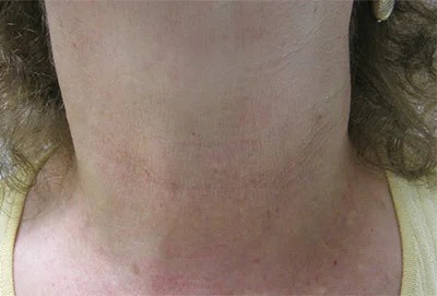 Fractional Laser Before & After Patient #1863