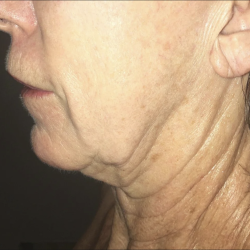 Morpheus8 Before & After Patient #2153