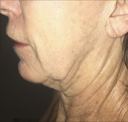 Morpheus8 Before & After Patient #2153