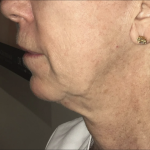 Morpheus8 Before & After Patient #2153