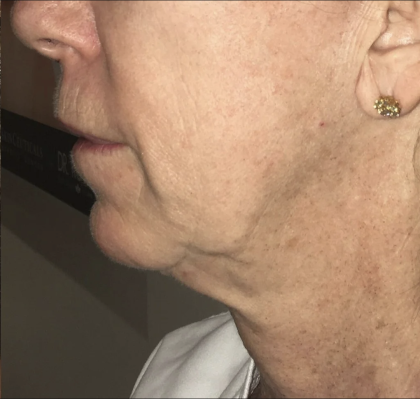 Morpheus8 Before & After Patient #2153
